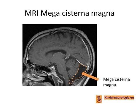 is mega cisterna magna dangerous